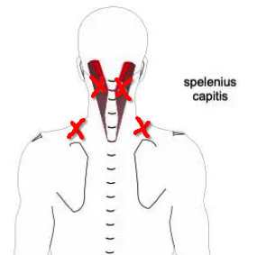 Trigger Points